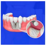 dental implants in mumbai